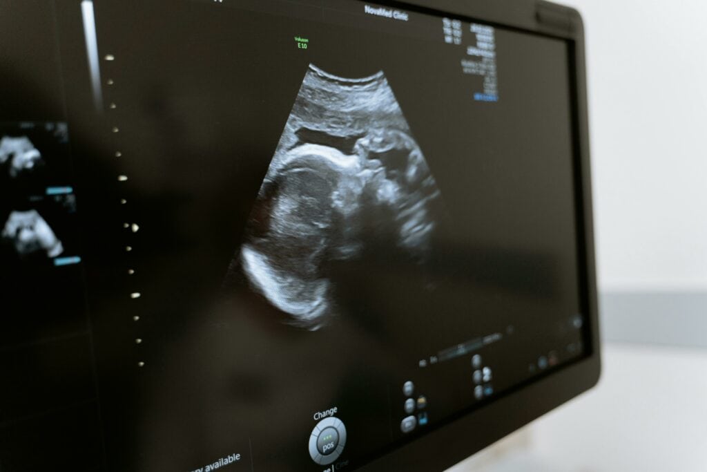 Das Bild einer Ultraschalluntersuchung auf einem Monitor.